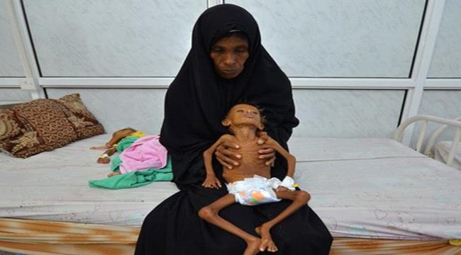 اليونيسف: إثنين مليون طفل يمني يعانون من سوء التغذية الحاد