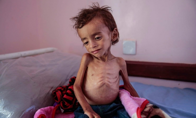 الصحة العالمية: أكثر من 16 مليون يمني بحاجة ماسة للرعاية