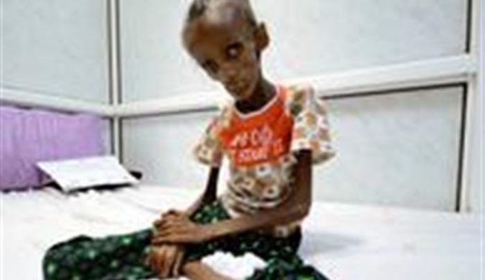 منظمة اللاجئين الأممية تحذر من سوء التغذية في اليمن