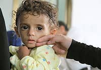 15 ألف طفل يمني يعانون من سوء التغذية الحاد