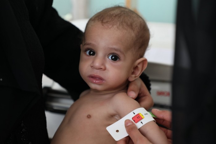 ضعف برامج التغذية يفاقم معاناة أطفال اليمن